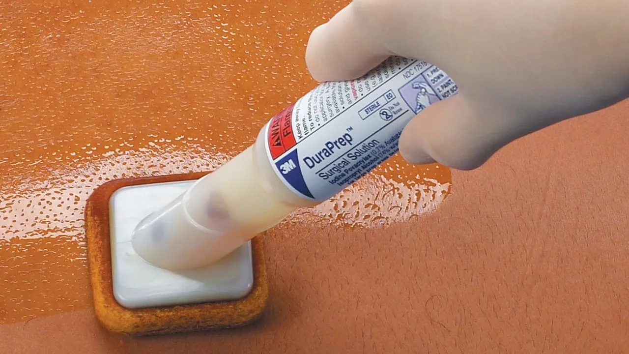 Iodine Povacrylex in Alcohol vs Chlorhexidine Gluconate A Comparative