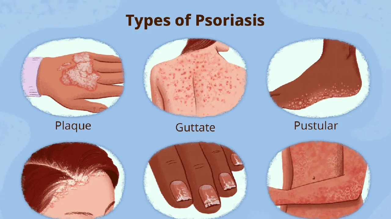 Understanding And Managing Psoriasis In Adults A Comprehensive Guide 