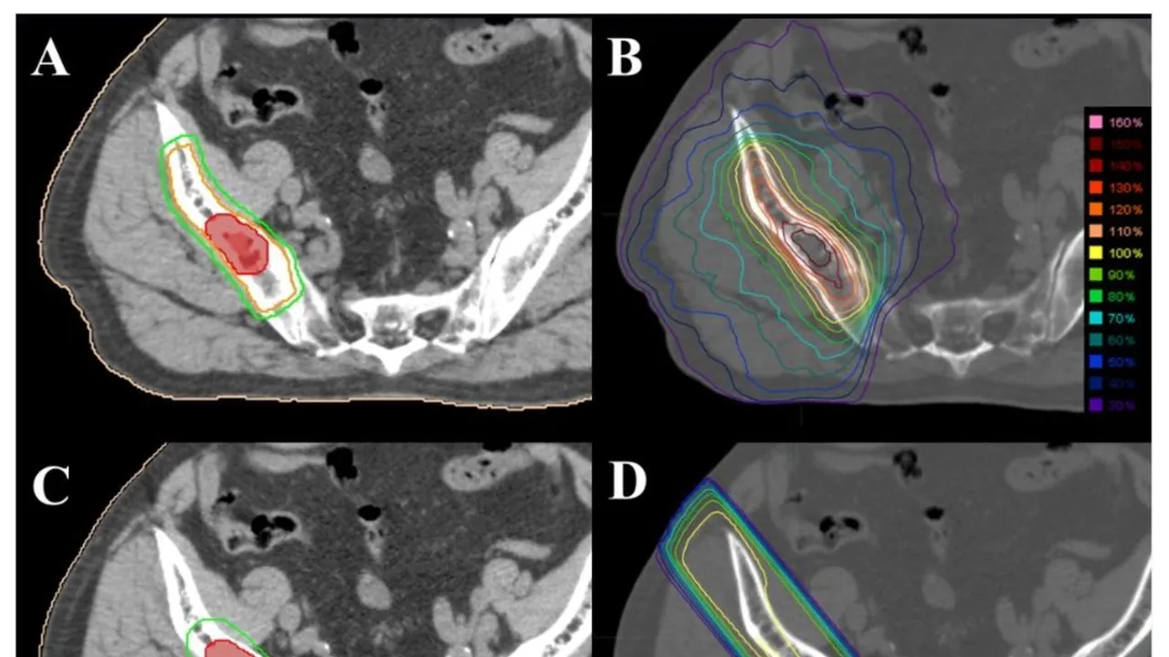 Stereotactic Body Radiotherapy A Safe and Effective Treatment for