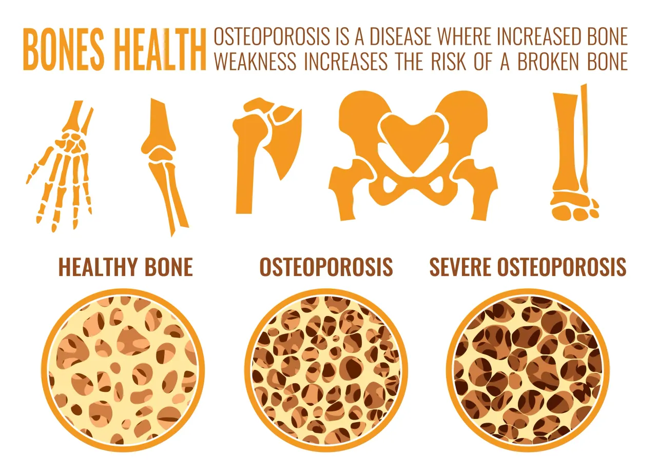 Strong Bones for Life: Preventing Osteoporosis and Promoting Bone Health