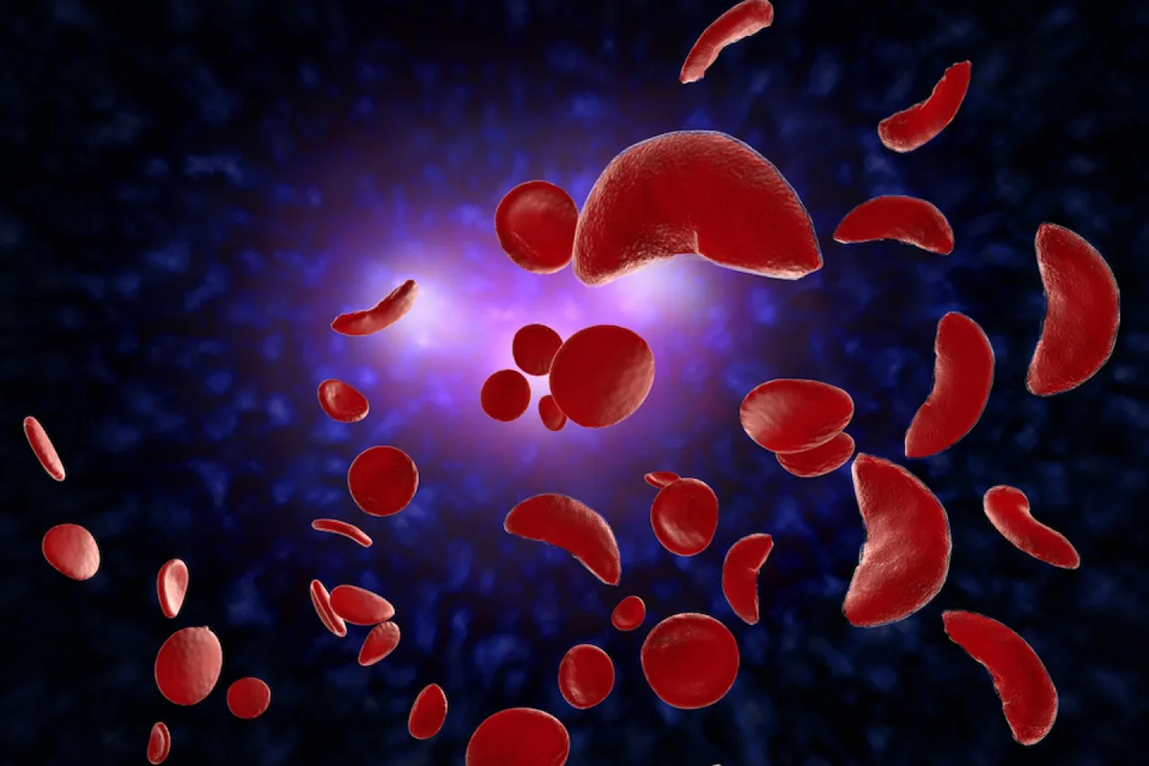 Sickle cell anaemia.jpg