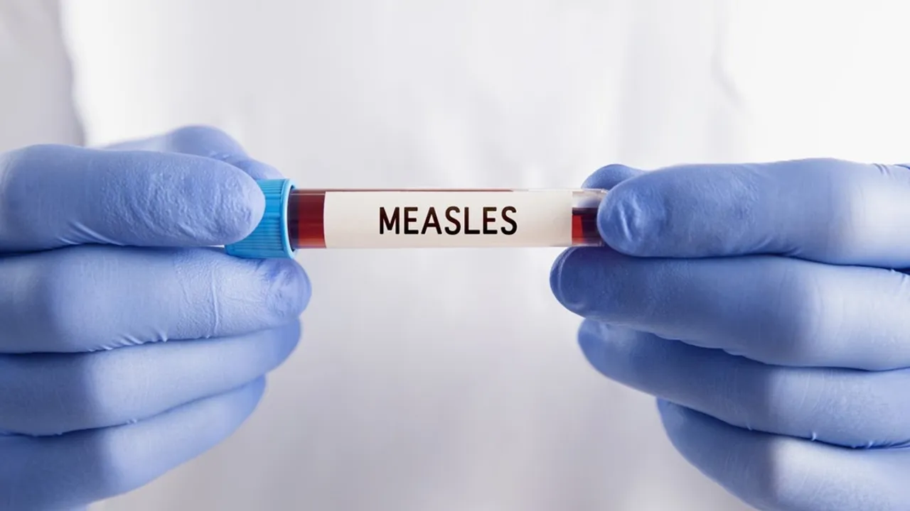 India bags prestigious award for efforts to combat measles, rubella
