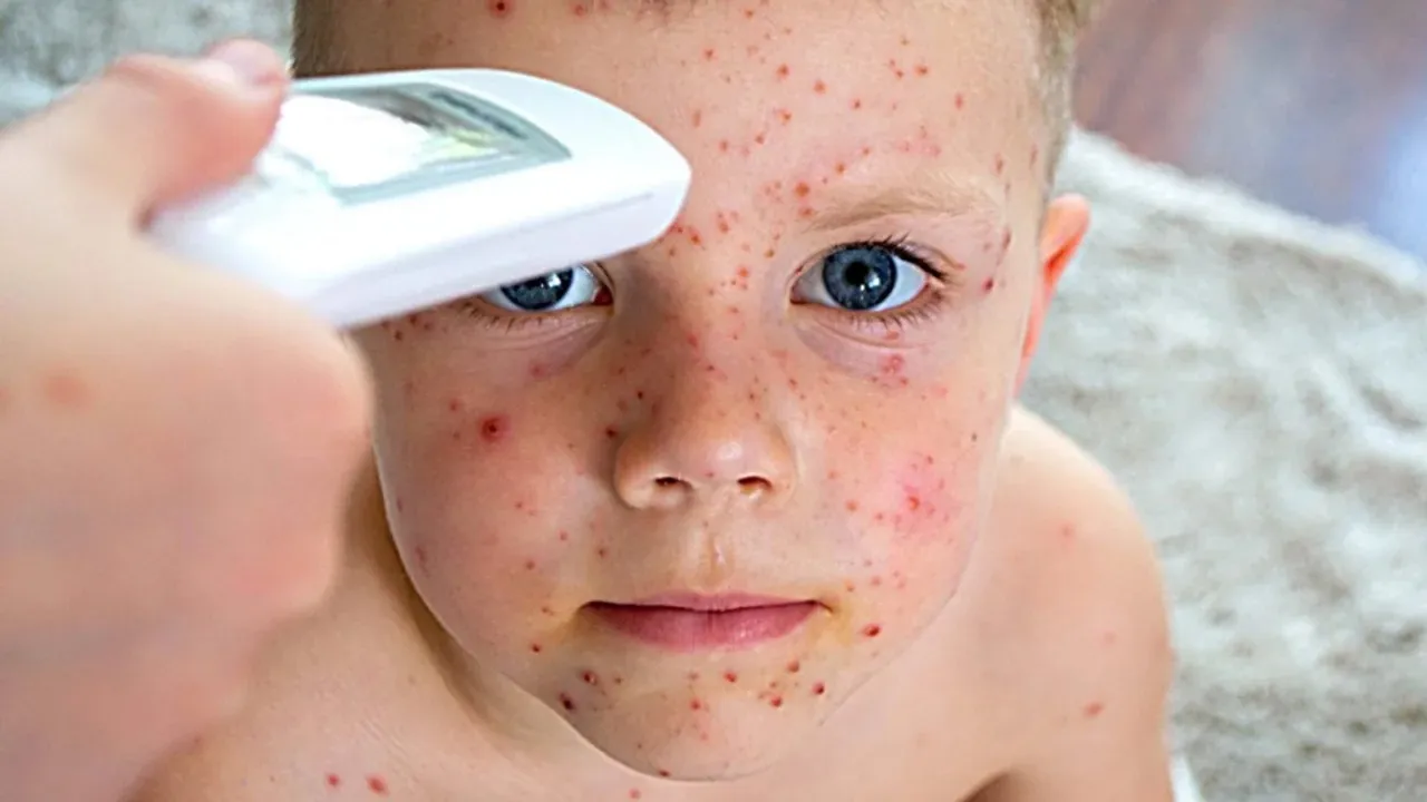 43% increase in global measles deaths from 2021-2022: WHO