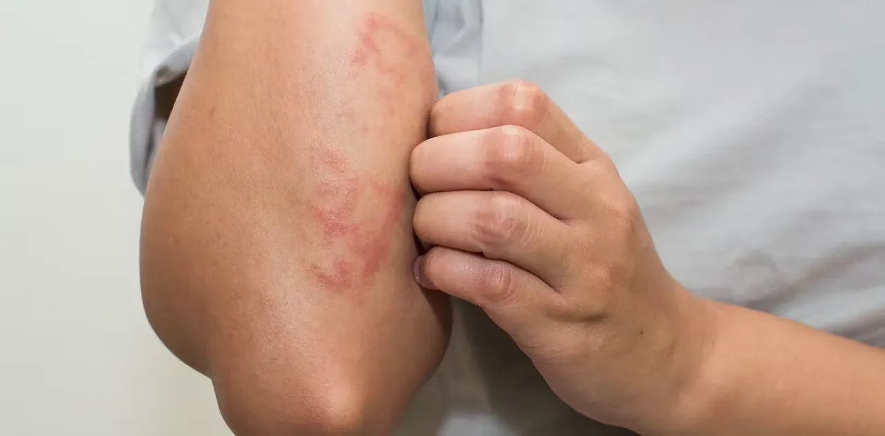 eczema.jpg