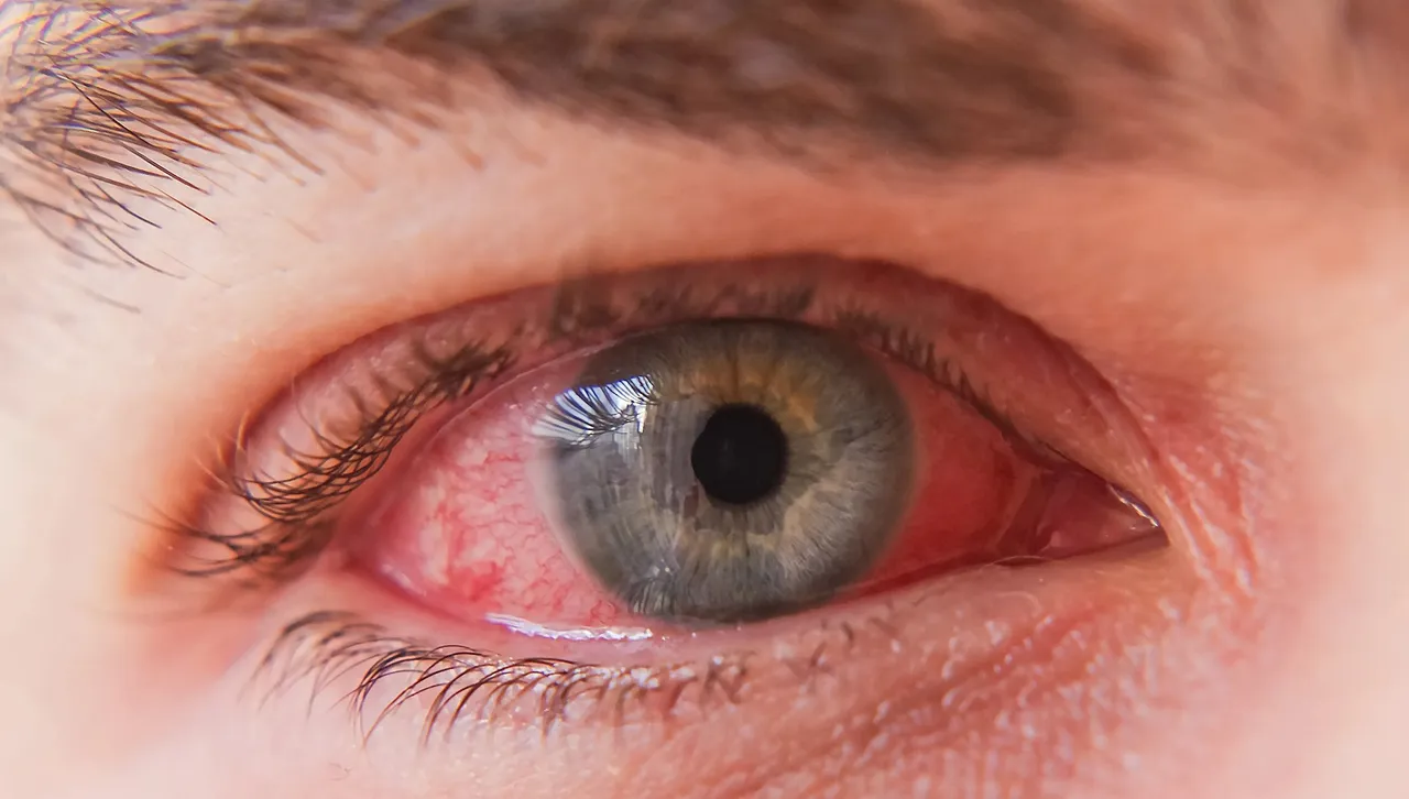 Yes, you can get syphilis of the eye – professor of ophthalmology explains
