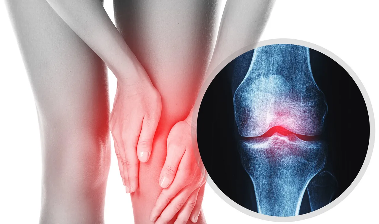 Nearly one billion people globally will have osteoarthritis by 2050: Lancet study