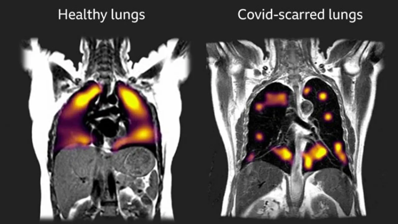 COVID-19 can cause lasting lung damage â 3 ways long COVID patients' respiration can suffer