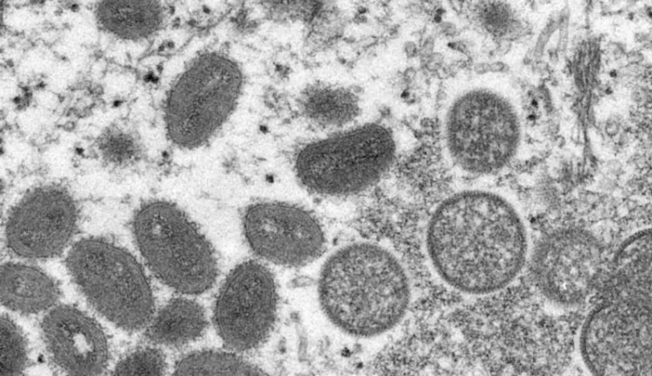 Medical kit developed for detection of Monkeypox virus