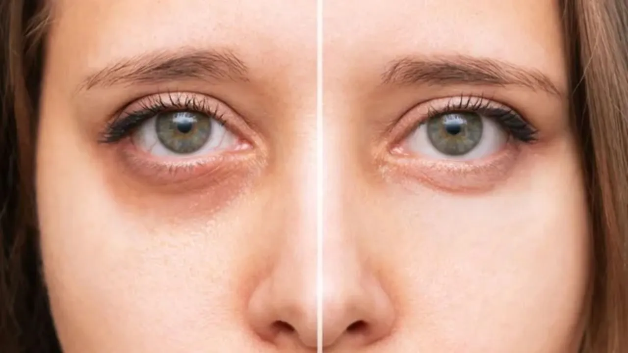 Dark Circles Removal Cream