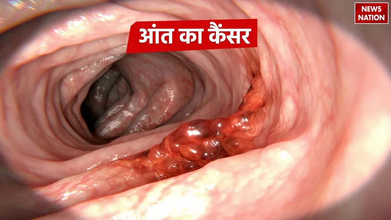 Colon or Bowel Cancer
