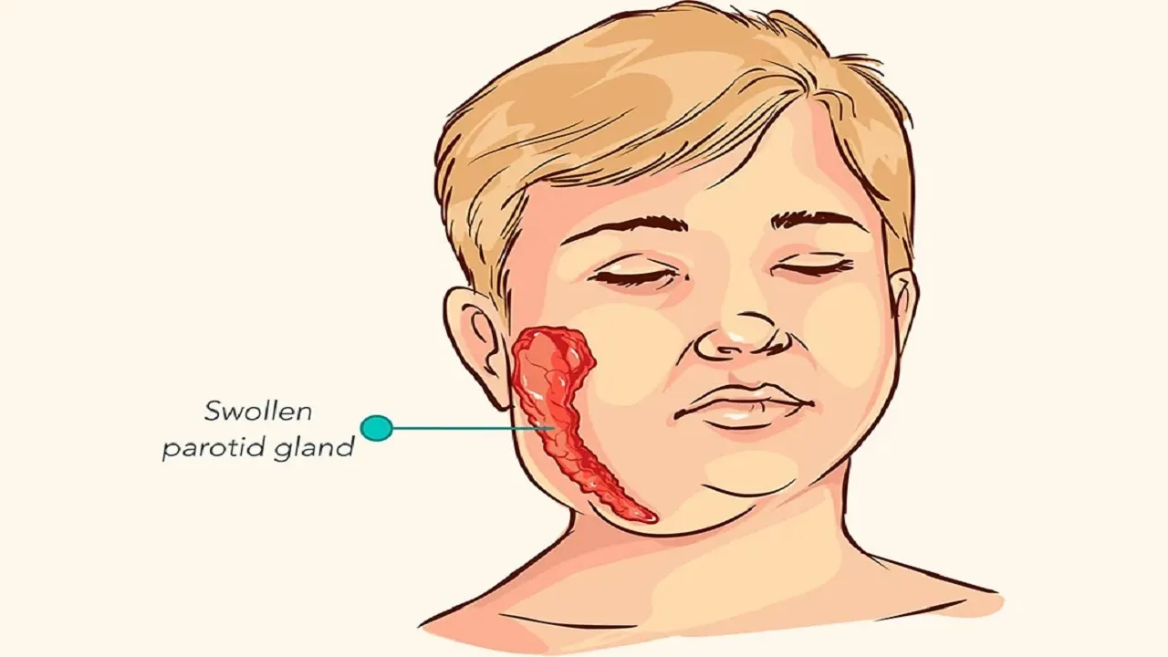 Mumps Disease