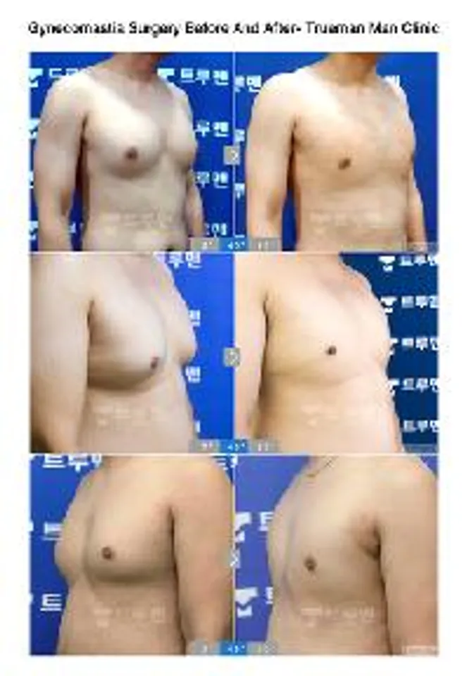 Trueman Man Clinic Network Demonstrates Its Excellence in Gynecomastia Surgery in Korea with 25,700 Operations