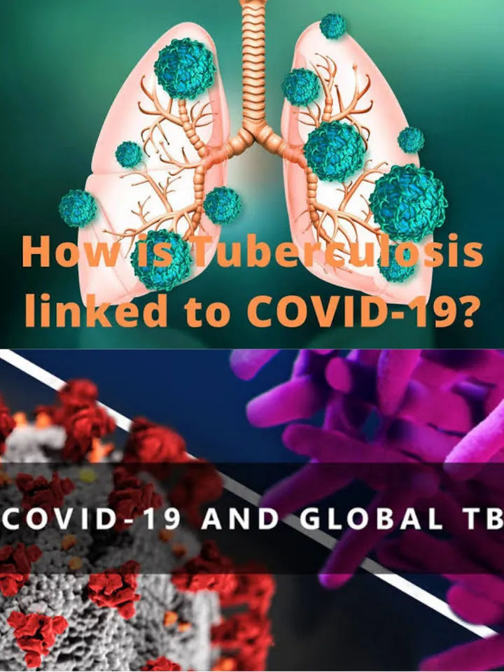 Tuberculosis due to Covid : This is the Painful Treatment for Tuberculosis if Cough Persists :