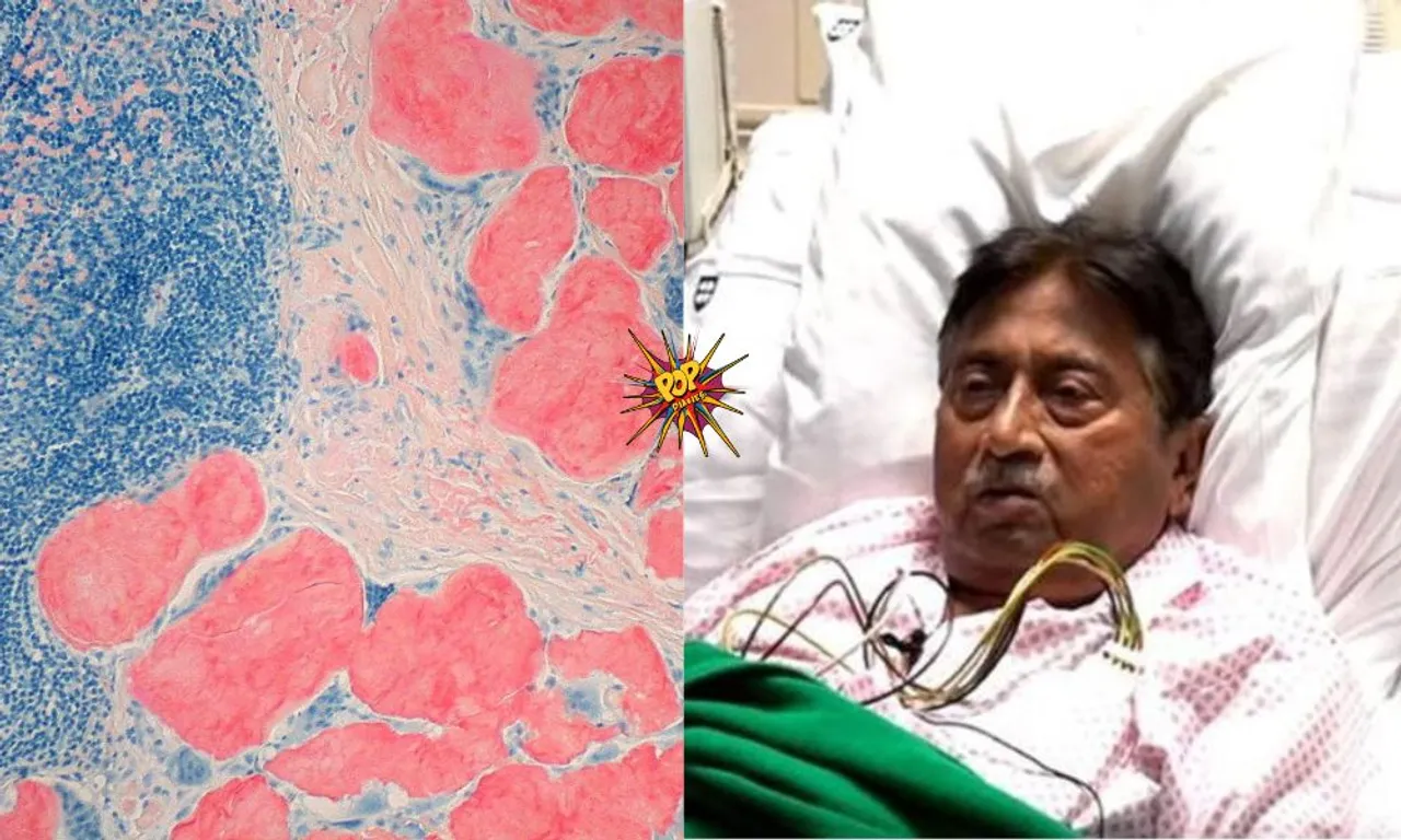 Here Is All You Need To Know About 'Amyloidosis' A Disease That Has Worsened The Health Of Former Pakistan President Pervez Musharraf