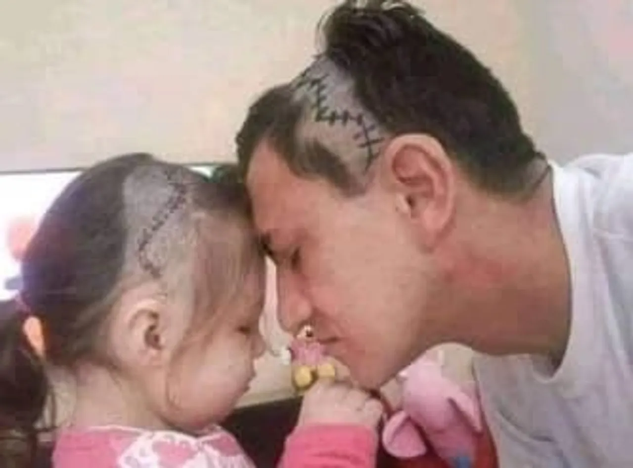 Love of a Father: Man Shaves Head to Look Like His Daughter After Her Brain Surgery. It literally left the Internet in Tears