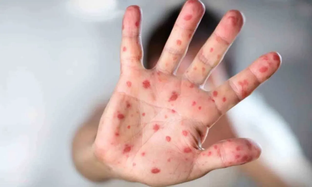 Health Experts Warns about Tomato Flu, Says Virus ‘Very Contagious’