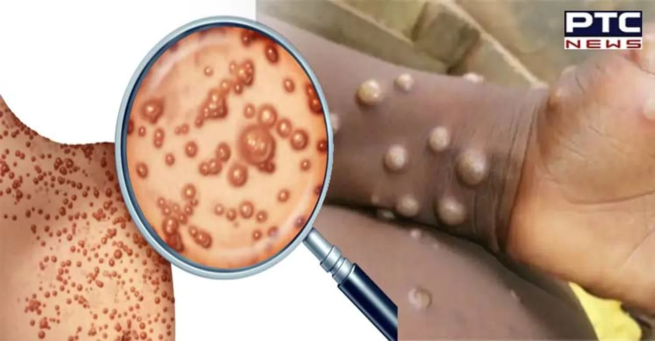 Argentina confirms 6th case of monkeypox