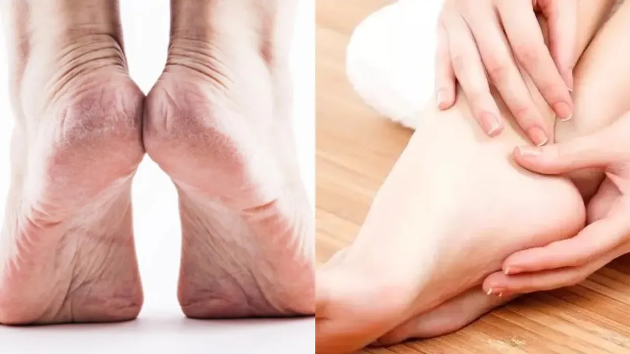 Feet Tips: ఎండాకాలం పాదాల పగుళ్లను నివారించే సింపుల్‌ చిట్కాలు