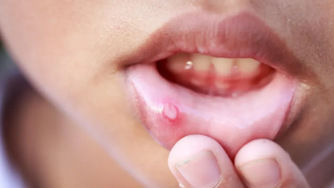 Mouth Ulcer: మౌత్ అల్సర్ ఇబ్బంది పెడుతుందా? ఈ హోం రెమెడీస్ పాటించండి!