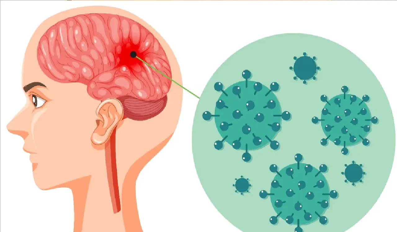 Viral meningitis