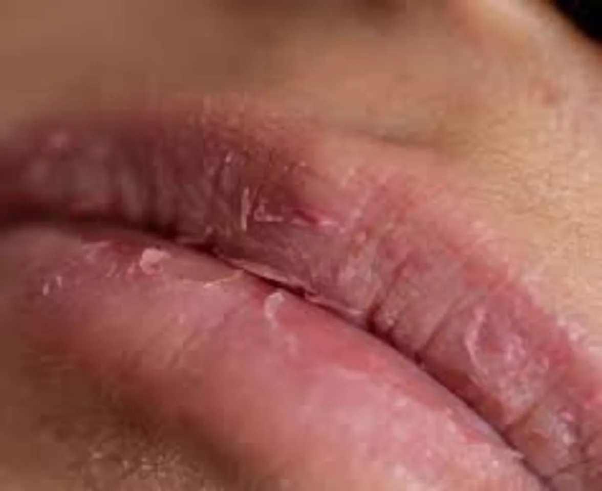 chapped-lips
