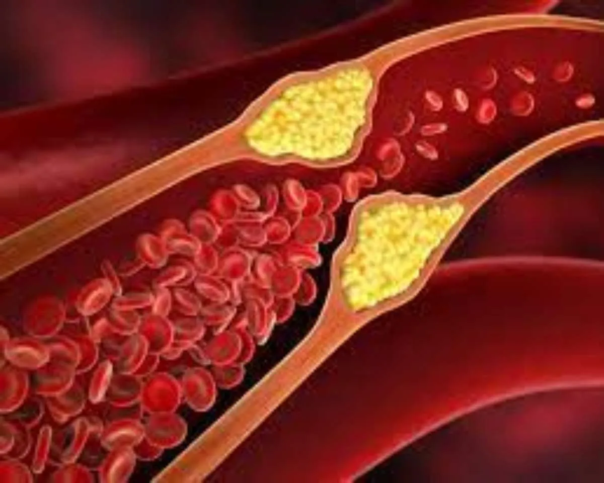 high cholesterol