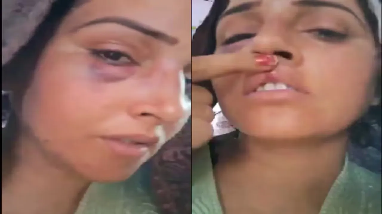 Seema Haider's Viral Video Reveals Swollen Eye & Lip Injury: What Happened?