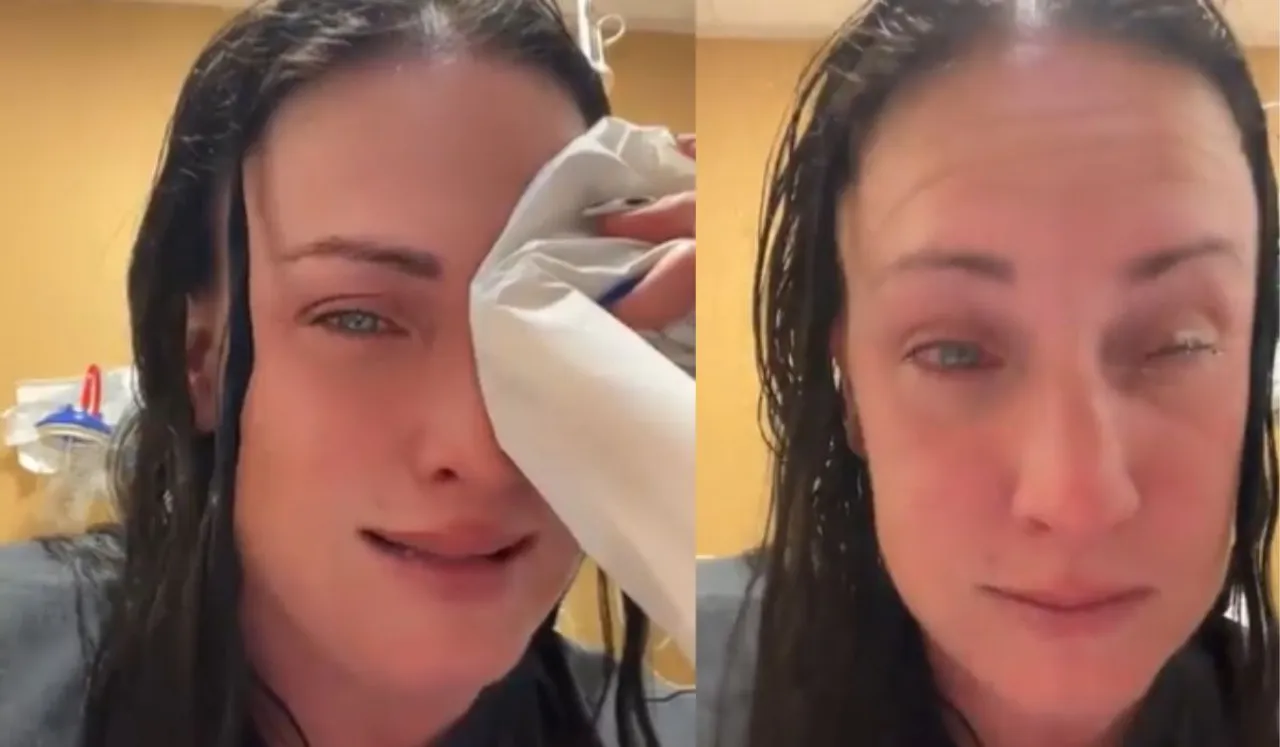 US Woman Mistakes Super Glue For Eye Drops, Shares Ordeal Online