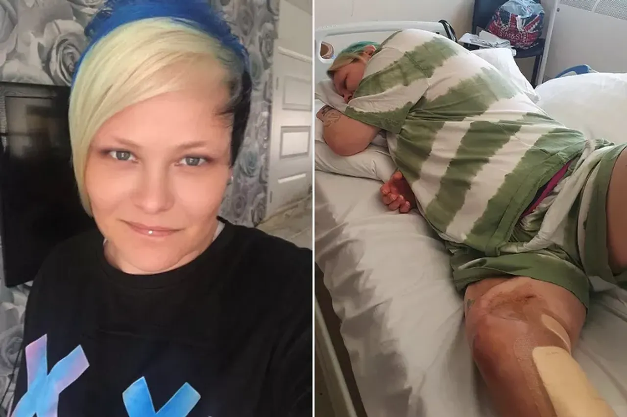 UK Mom Desperate For Amputation After 55 Surgeries On Her Leg