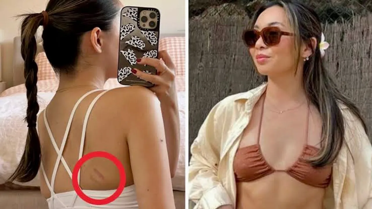Influencer Reveals How Routine Check Up Diagnosed Her Skin Cancer