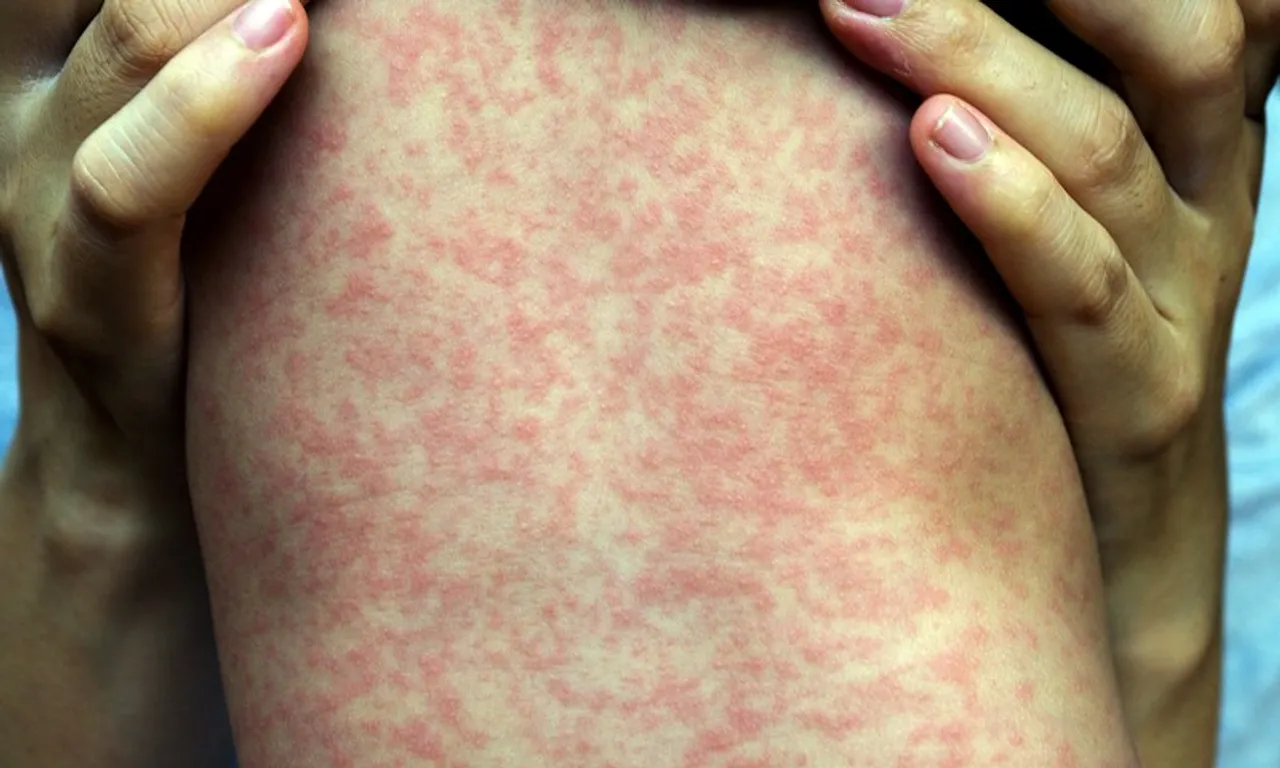 measles deaths up by 40 percent