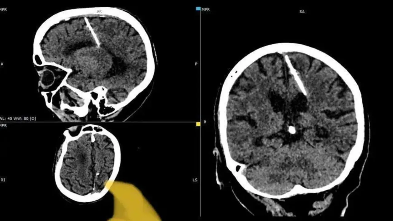 Now 80, This Woman Has Been Living With Needle In Brain Since Birth