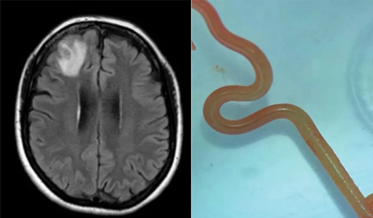 In A First, Live Parasitic Worm Found In Australian Woman's Brain