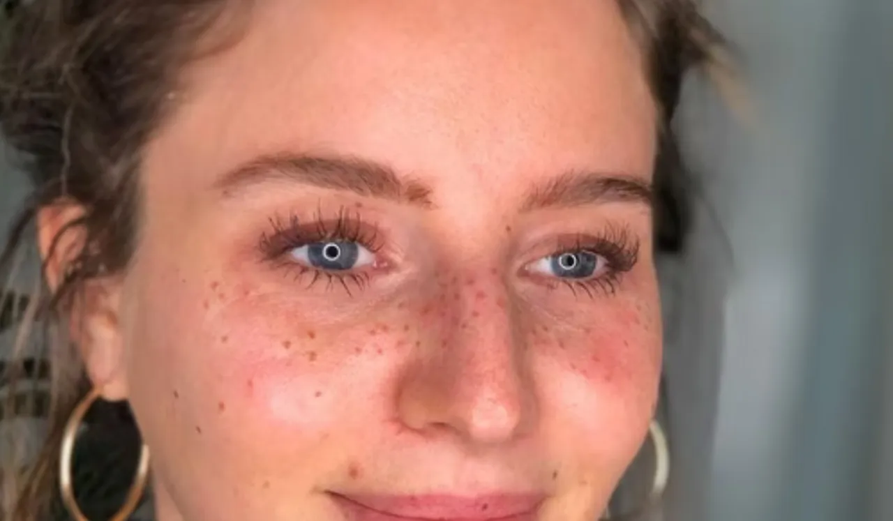 What Is Permanent Freckles TikTok Trend And Why Is It Dangerous?