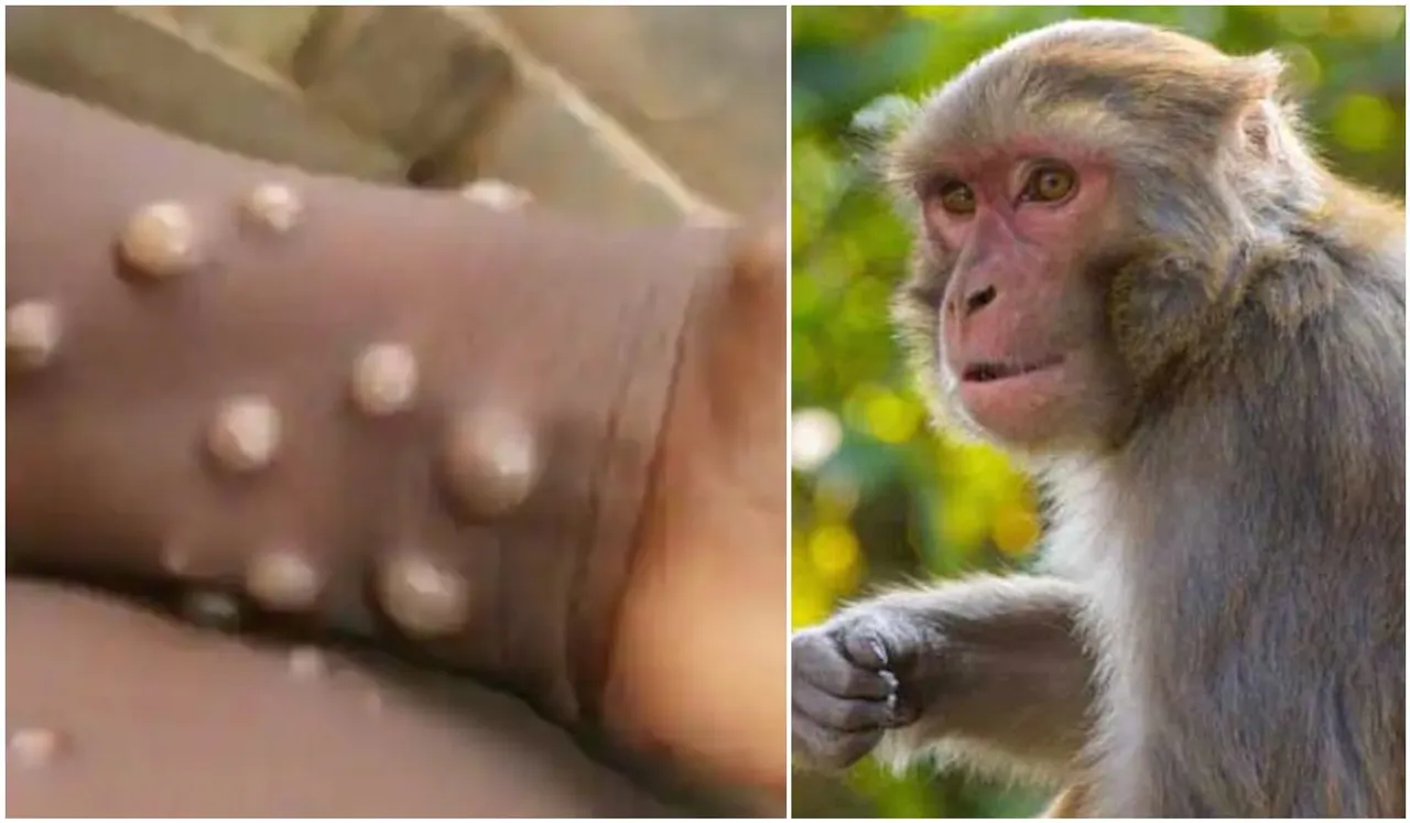 What Are The Symptoms Of Monkey B Virus Infection?