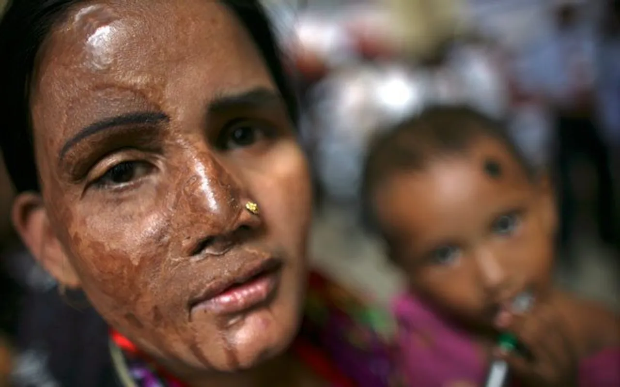 Despite Having Special Provisions In Law Acid Attacks In India Are Still Rampant; Why?