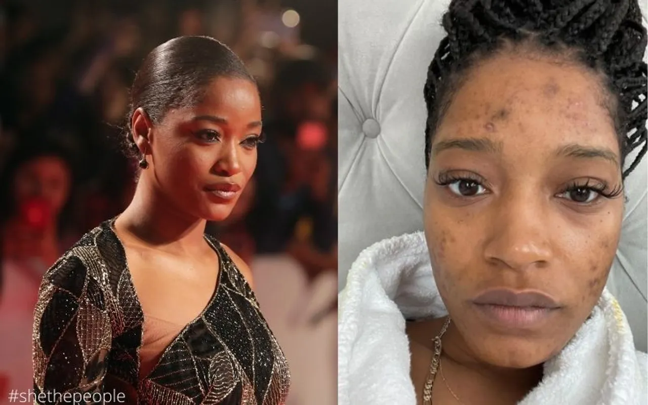 Keke Palmer Opens Up About Her Struggles With PCOS