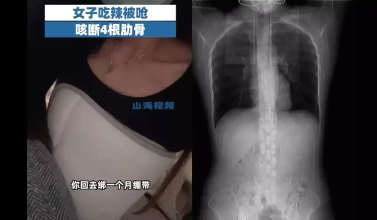 Woman Fractures 4 Ribs While Coughing After Eating Spicy Food
