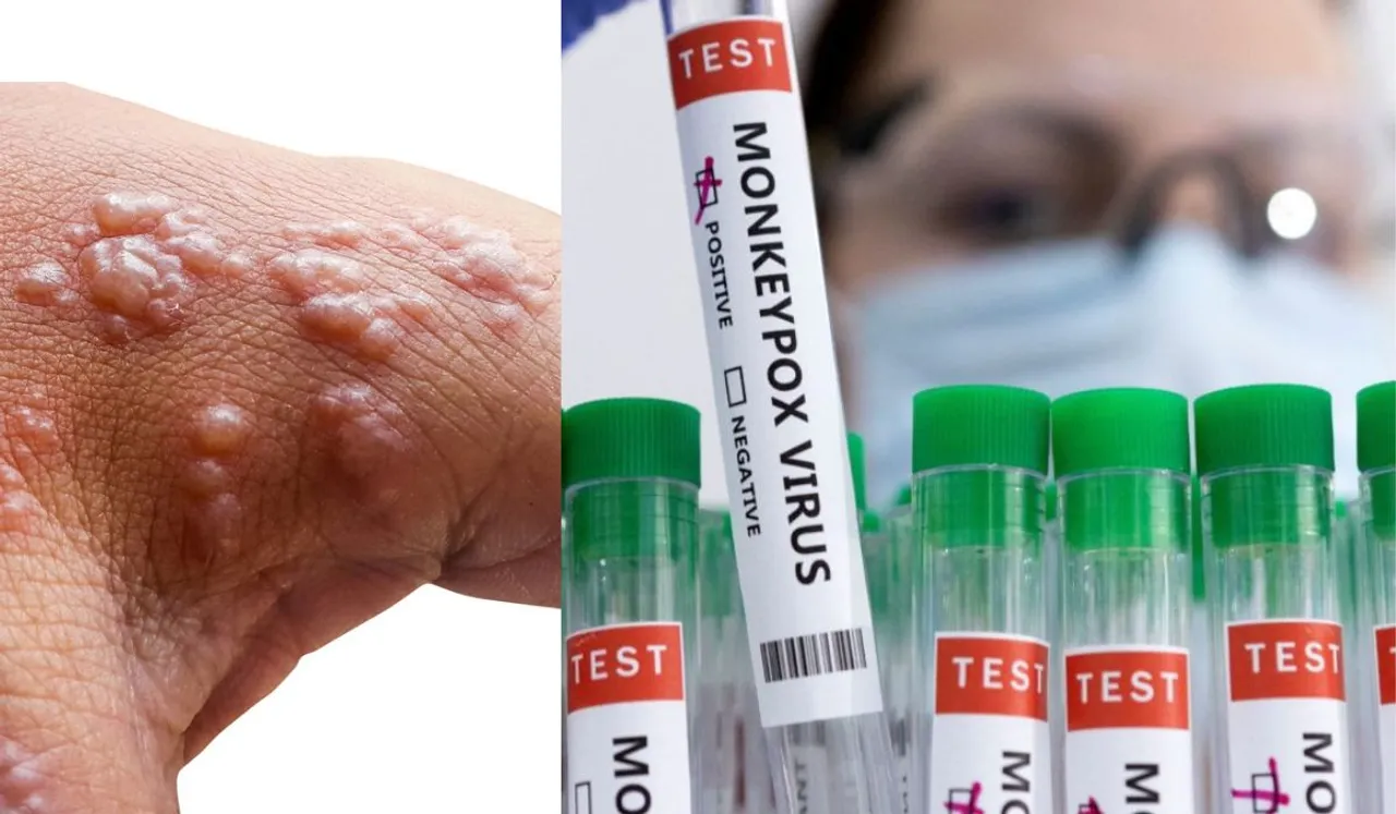Monkeypox Virus, how does monkeypox spread, monkeypox misinformation
