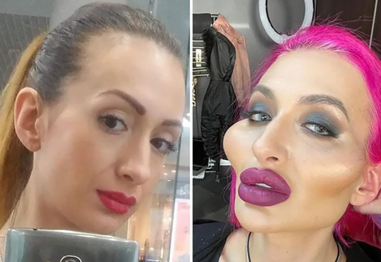Who Is Anastasia Pokreshchuk? Model With 'World's Biggest Cheeks' Gets More Implants