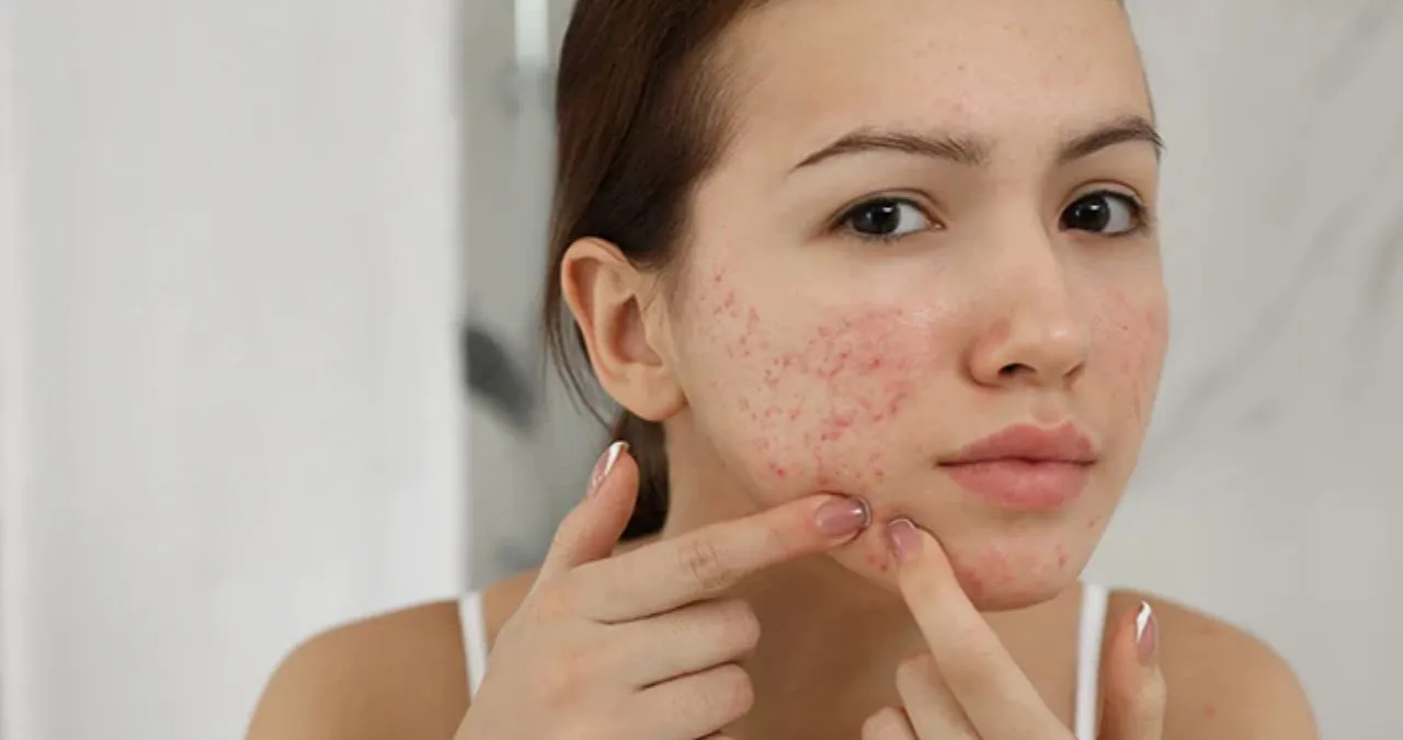 Acne and Pimple solutions