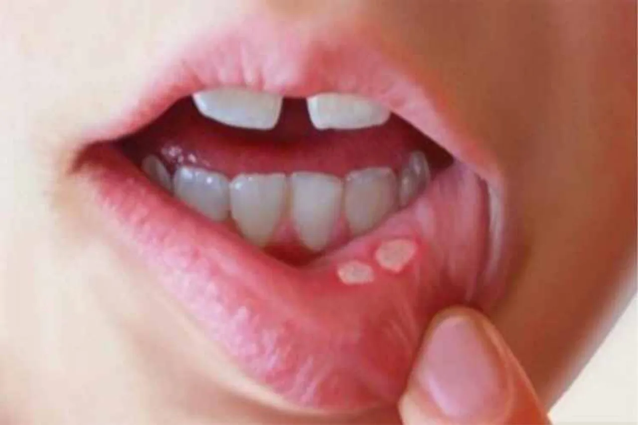 mouth,ulcers,remedies, Trouble