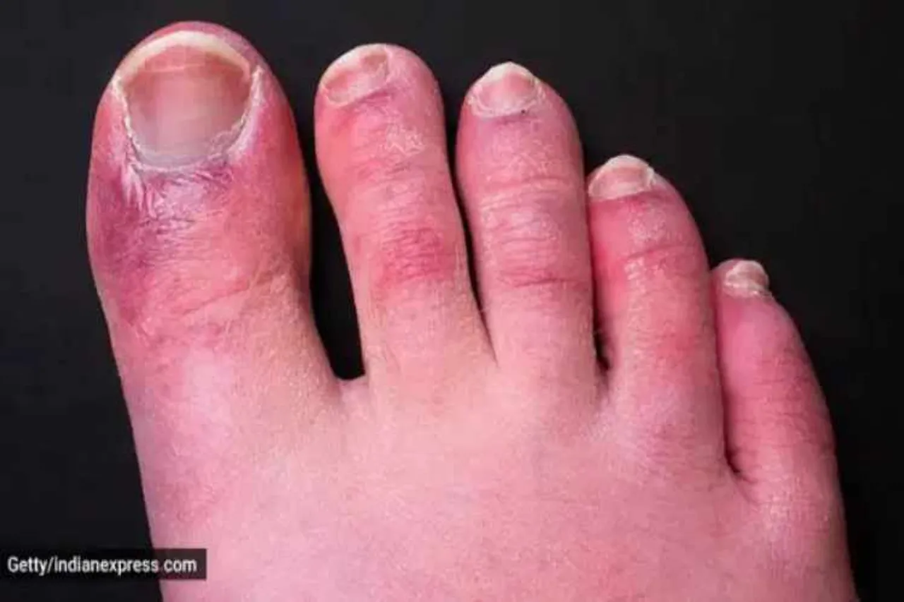 corona virus, symptoms, toes, what is covid-toes' symptom in kids, covid-toes' symptom, reddening and swelling of skin, parenting, indian express, indian express news