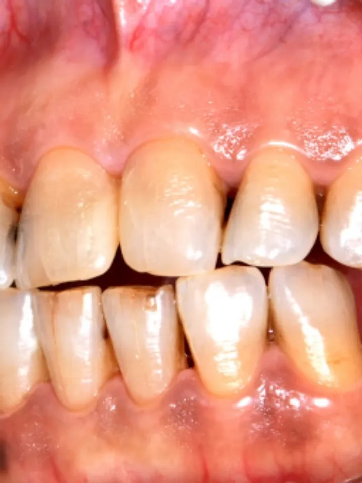 tooth discolouration 1 - unsplash (1)