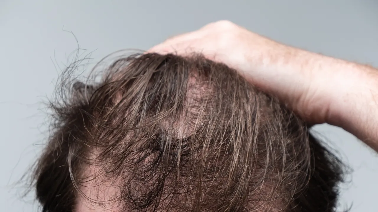 Weight Loss Treatments Linked to Potential Hair and Skin Problems, Health Advisory Warns