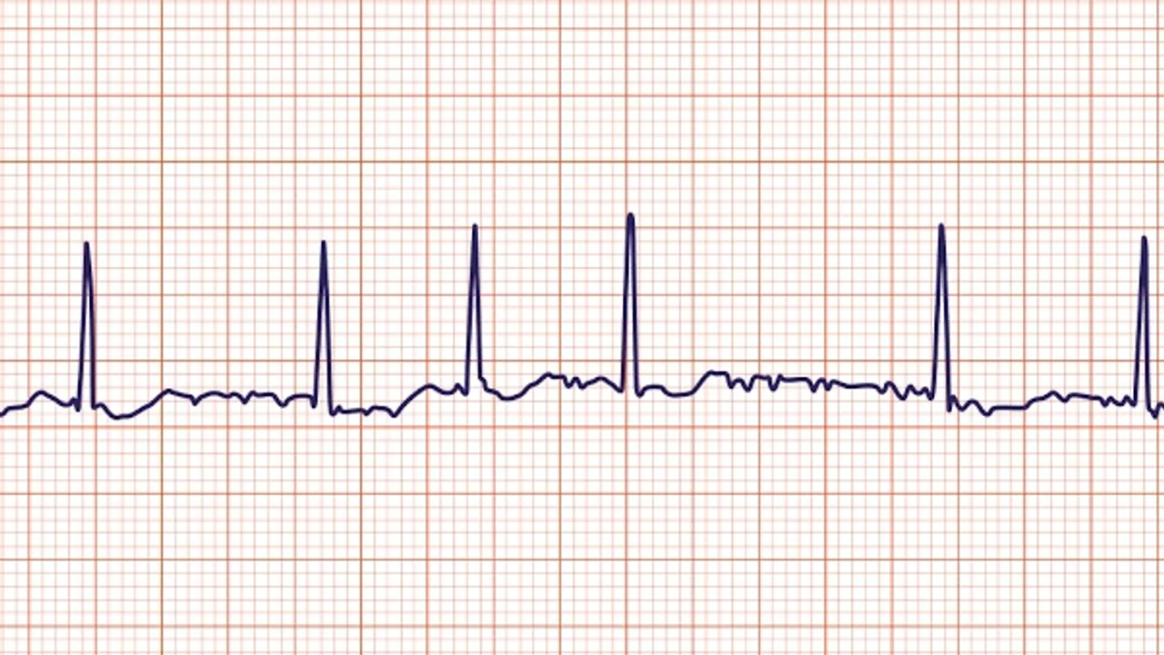 Atrial Fibrillation Increasingly Common and Risky in Younger Adults, Study Finds