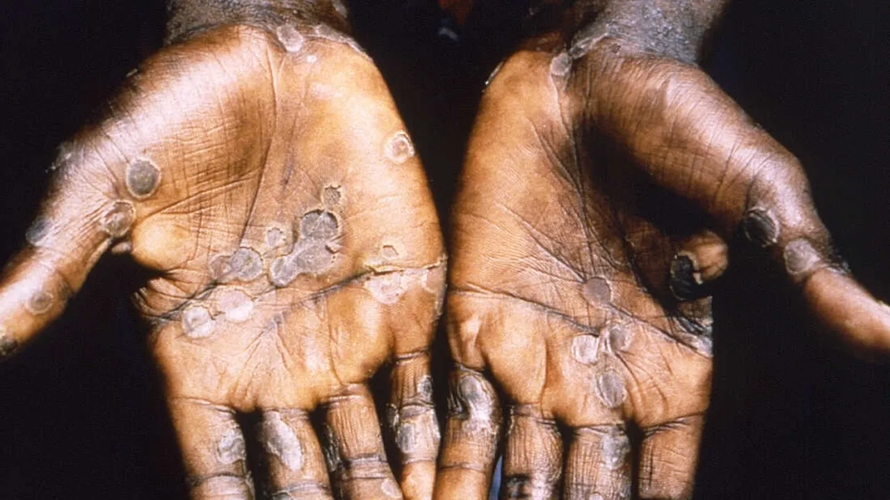 Monkeypox Outbreak in DR Congo's Équateur Province Claims Over 250 Lives
