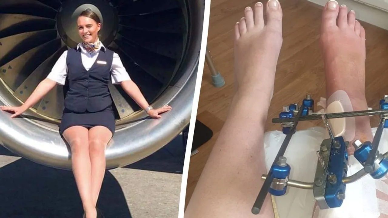 Former Air Stewardess Wins Six-Figure Settlement After Severe Leg Injury on Flight