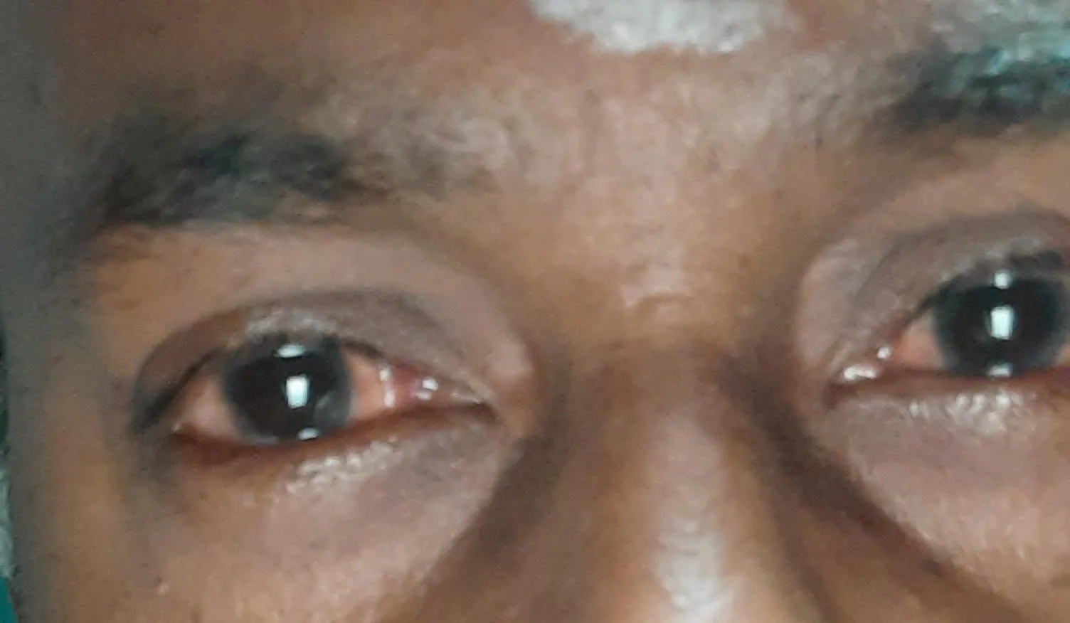 Madras eye