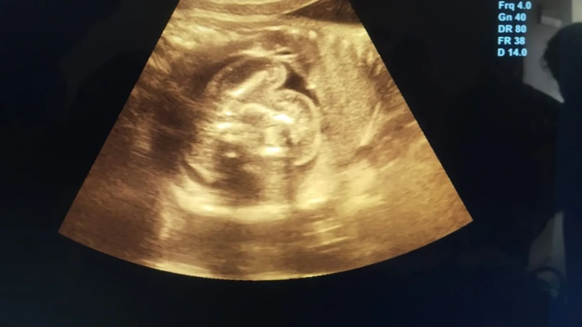 Foetus